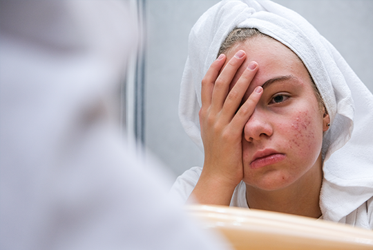 Oily Skin: Causes and Treatments