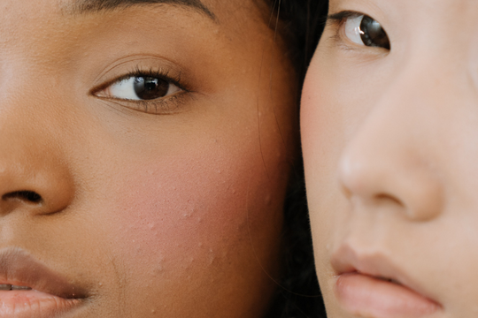 The Best Skin Care Routine for Treating Acne-Prone Skin